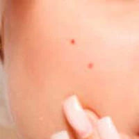 ACNE & BREAKOUTS