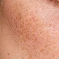 FRECKLES