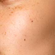 SENSITIVE SKIN